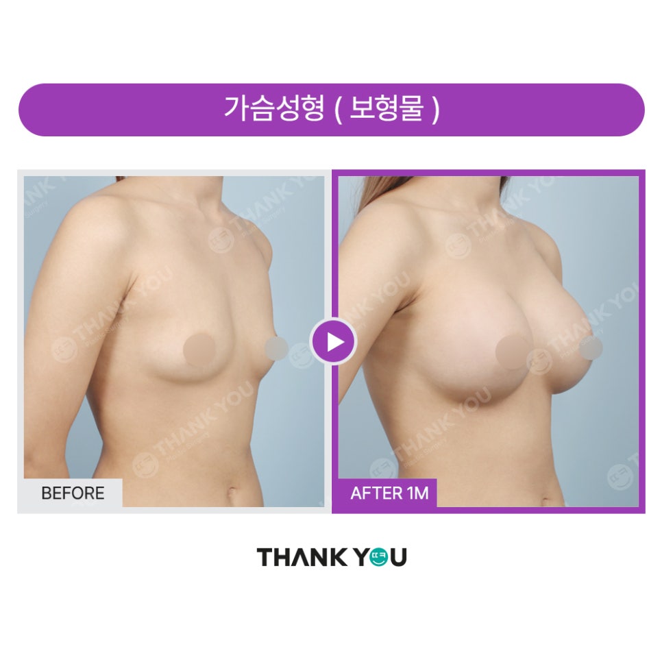 강남 가슴성형외과, 흉곽과 체형을 고려한 모티바보형물 관련 이미지 16