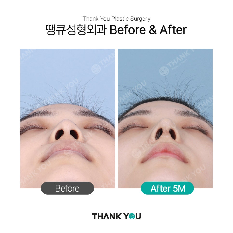 남자코성형 여자코성형 디자인 차이점 (코성형 전후) 관련 이미지 7