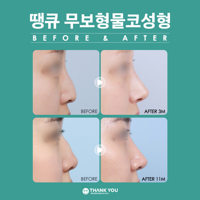 무보형물코성형 재료에 따른 특징을 알아보자! 관련 이미지 4