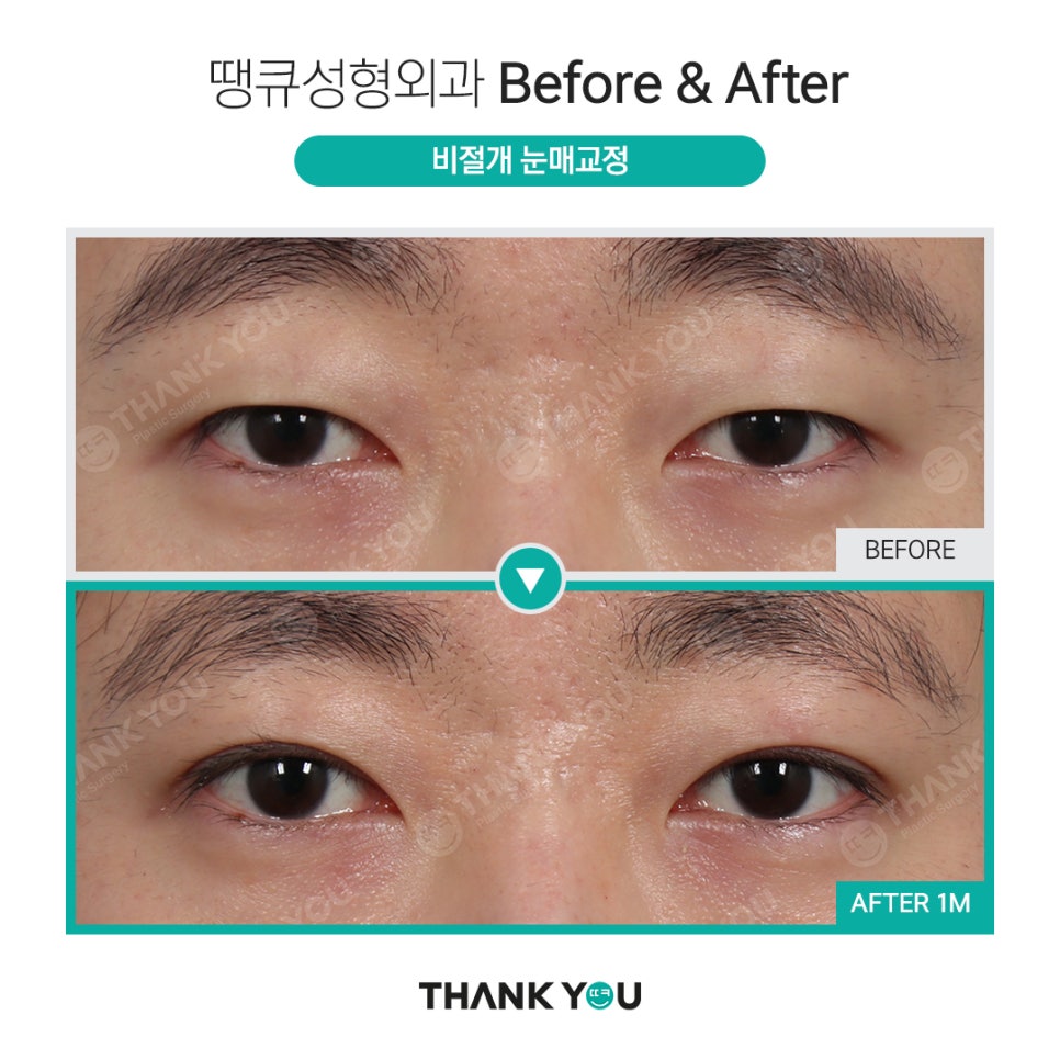 [남자 쌍수후기?] 망하기 싫으면 꼭 보세요! 관련 이미지 19