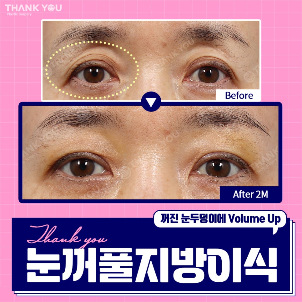 눈꺼짐? Thank You눈꺼풀 지방이식으로 볼륨UP 관련 이미지 3