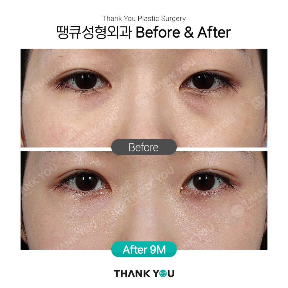 땡큐에서 알려드리는 눈밑지방재배치 Check point ❗ 관련 이미지 5