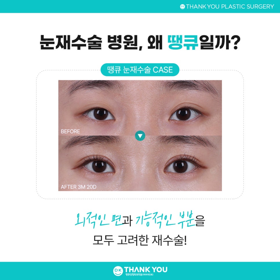눈재수술병원 잘 고르려면?! 맞춤 수술 여부가 핵심👍 관련 이미지 10