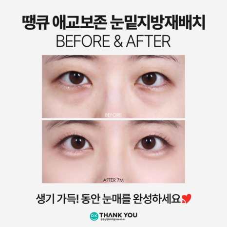 눈밑지전후 애교살에 변화가 생길까? [김다솜 원장 칼럼] 관련 이미지 7