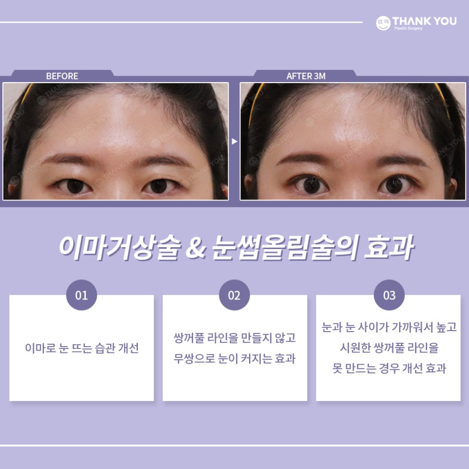 이마로 눈뜨기 개선하는 땡큐 눈썹올림술(거상술) 관련 이미지 2