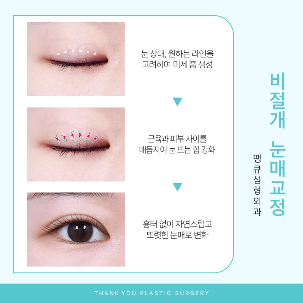 눈매교정잘하는곳 땡큐에서 더 또렷하게, 더 자연스럽게! 관련 이미지 4