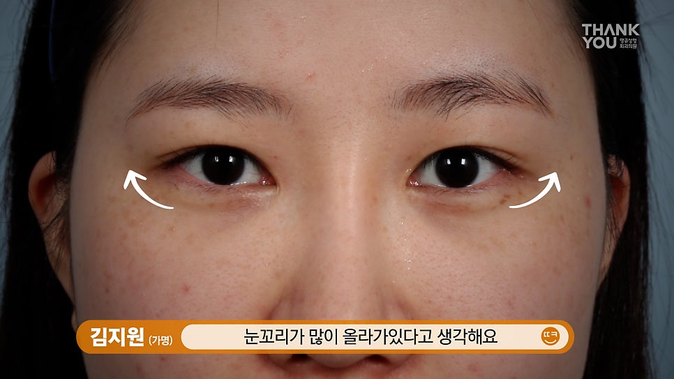 눈과 눈썹 사이 간격 넓히는방법? 이마거상술(눈썹올림술)로 시원하게 관련 이미지 8