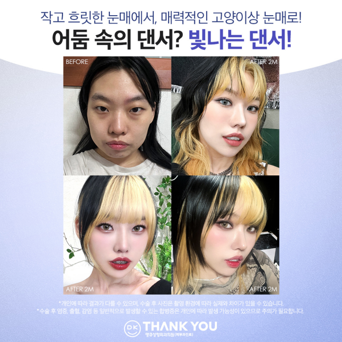 Improving Small, Faint Eyes with Non-Incisional Eye Correction Surgery ✨ (Make Me Girl Episode 7 Thank You Solution) image 7