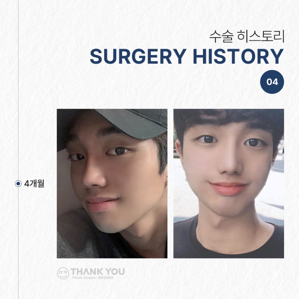 남자코성형후기, 코절골술로 매부리코를 매끈하게 관련 이미지 7