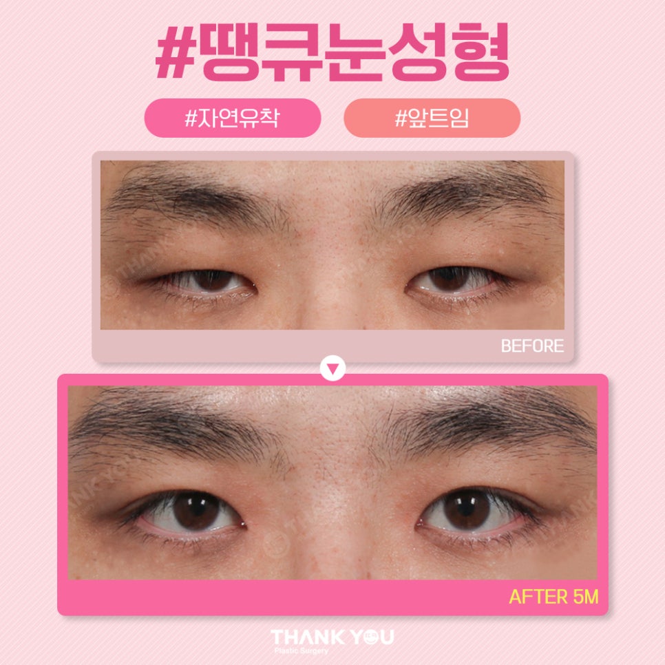 땡큐 쌍꺼풀 전후사진 비교 Before & After 관련 이미지 5