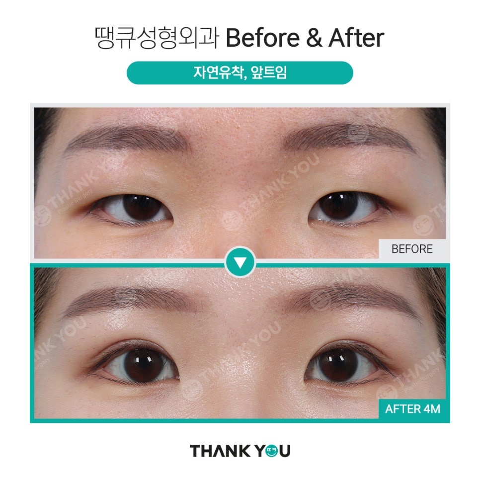 신논현역 성형외과에서 쌍수 전후 Check✨ 관련 이미지 6