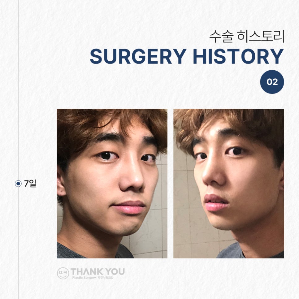 남자코성형후기, 코절골술로 매부리코를 매끈하게 관련 이미지 5