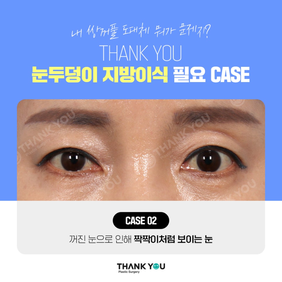 눈두덩이 지방이식, 푹꺼진 눈꺼풀에 자가지방이식으로 관련 이미지 6
