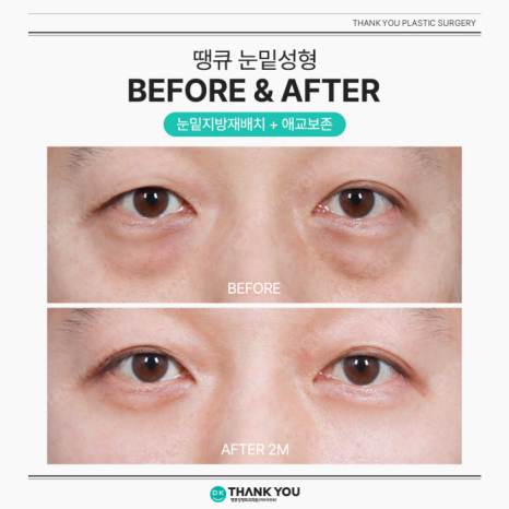 Lower Blepharoplasty and Under-Eye Fat Repositioning: What’s the Difference? image 10