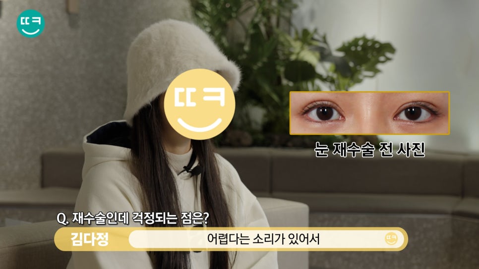 짝눈 쌍수 재수술, 짝짝이 라인과 비대칭쌍꺼풀 대칭 맞추기 관련 이미지 10