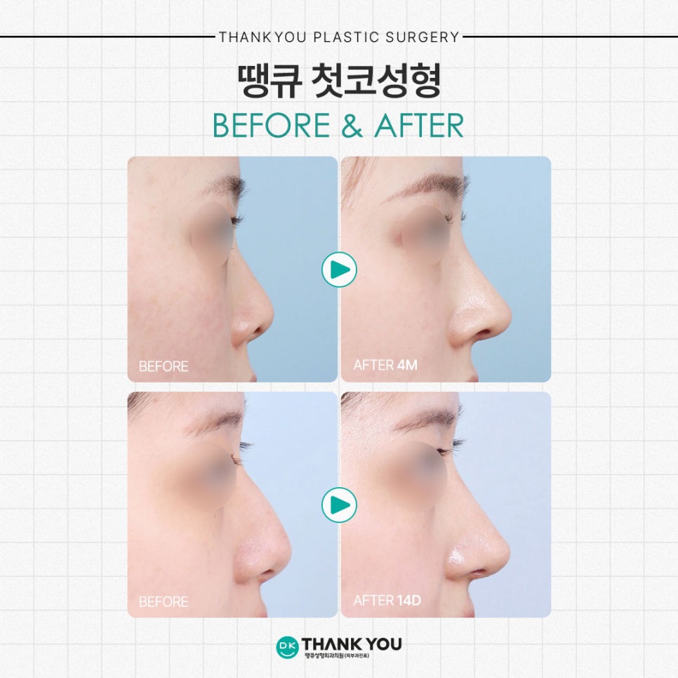 What Checkpoints Should You Consider Before Your First Rhinoplasty?! image 9