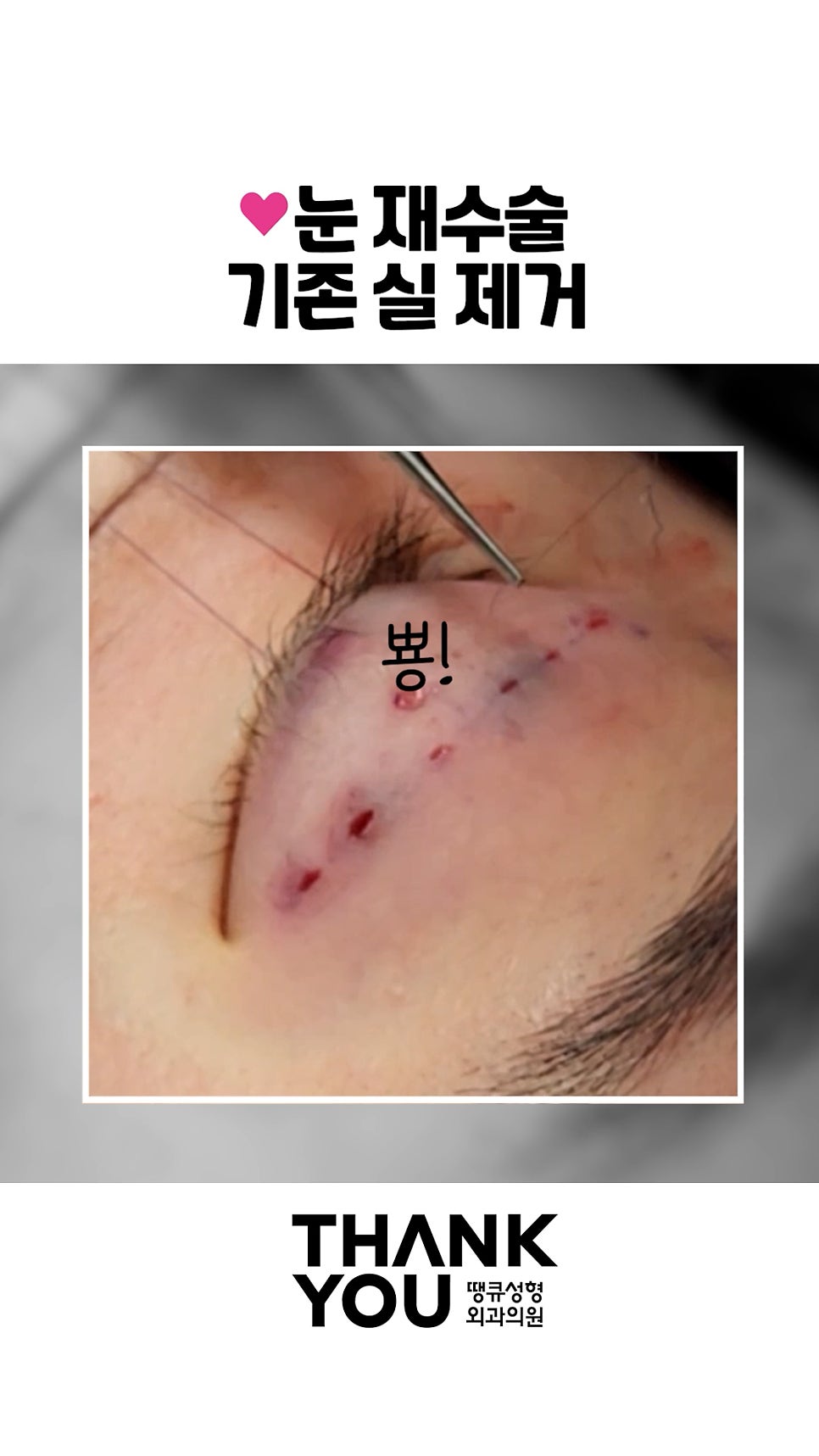 매몰 풀기, 매몰 실 제거 (15년 묵은 실)재수술 쌍꺼풀 관련 이미지 7
