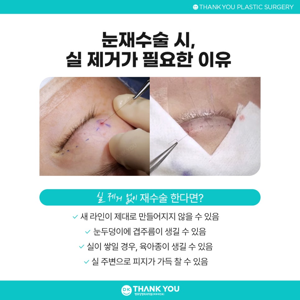 눈재수술병원 잘 고르려면?! 맞춤 수술 여부가 핵심👍 관련 이미지 5