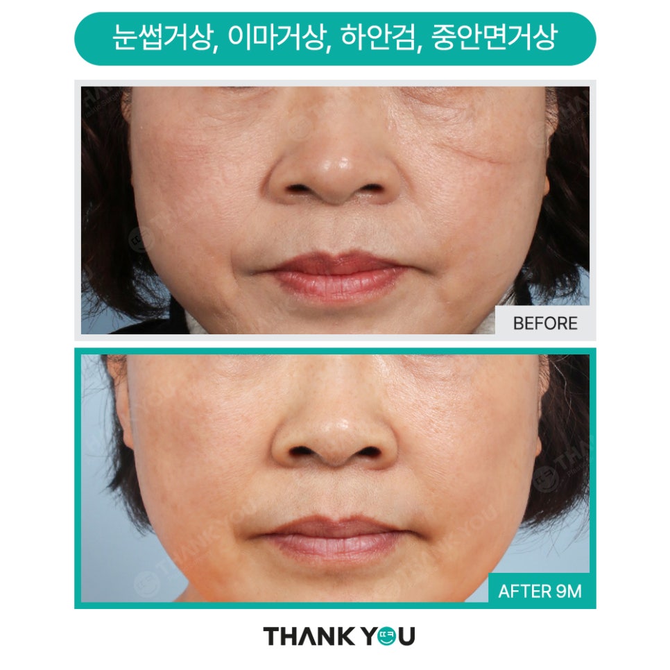 쌍꺼풀수술 없이 처진 눈 해결? [중년 이마거상/ 눈썹하거상술] 관련 이미지 9