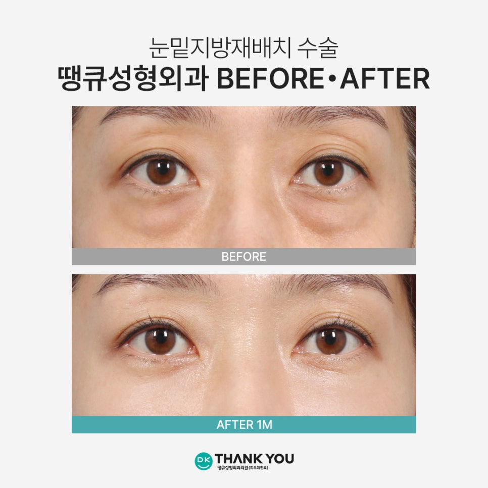 눈밑지방재배치 재발? 수술 후 눈 밑이 볼록한 이유 관련 이미지 7