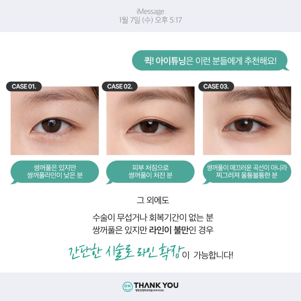 쌍꺼풀라인 절개 없이 확장하고 싶다면?! 땡큐 퀵!아이튜닝 관련 이미지 3