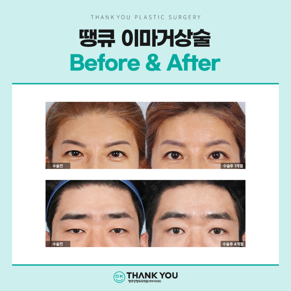 이마거상 흉터, 탈모 걱정된다면? 내시경이마거상술 총정리 관련 이미지 4