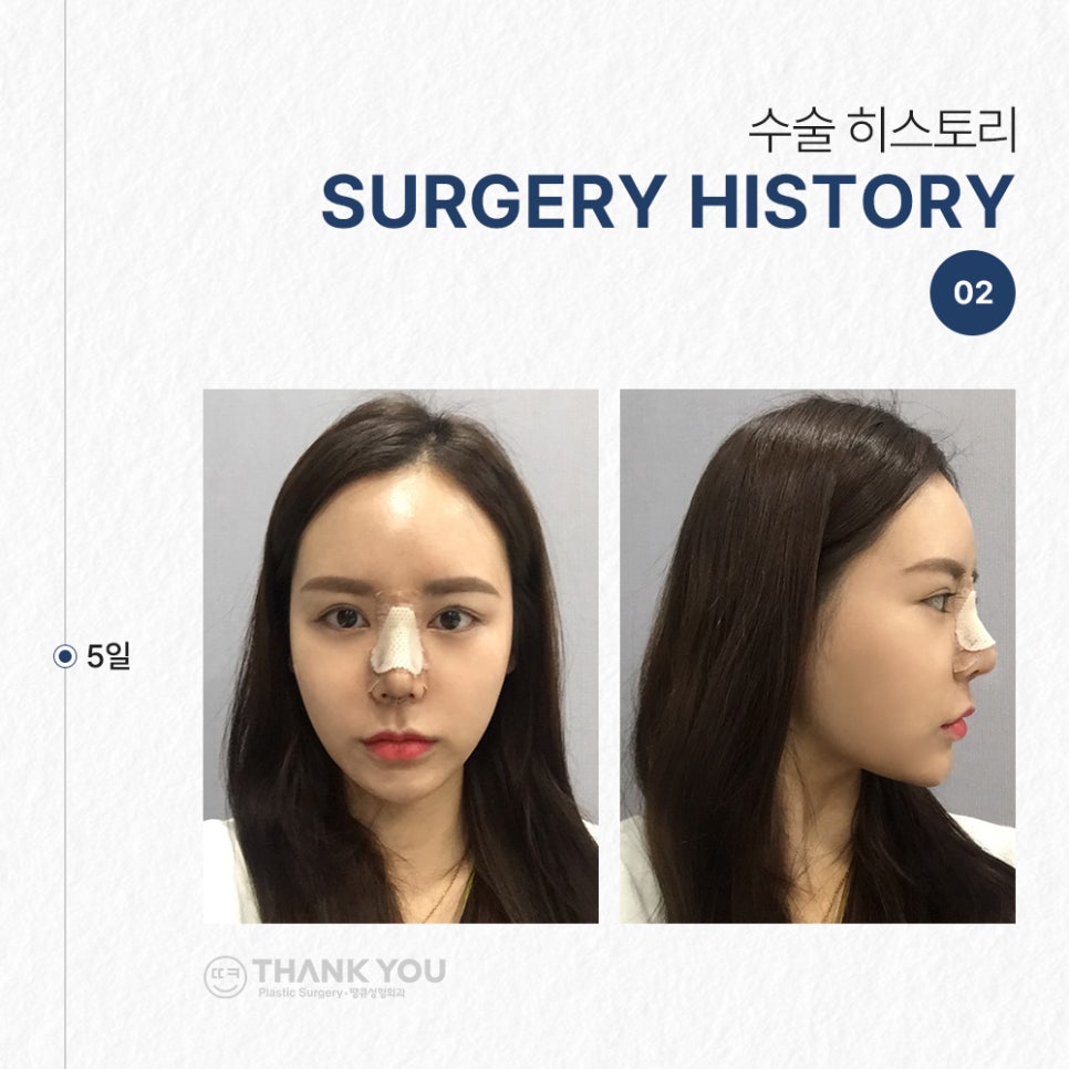 코필러 대신 여자코성형 (콧대+코끝)자연스럽게 관련 이미지 5