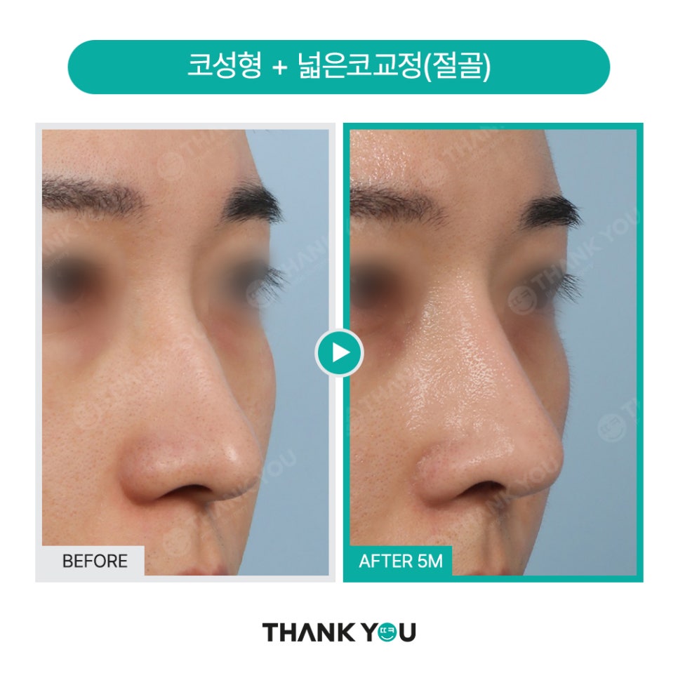 남자코성형 (휜코, 매부리코 등) 기능코성형 필요! [ft.코수술전후] 관련 이미지 19