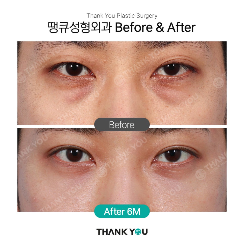 붐 눈밑지방재배치? 남자 눈밑지 전후 (붐, 남창희, 김동현) 관련 이미지 7
