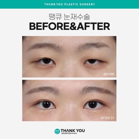 눈재수술병원 선택 시 신중해야 하는 이유는?! 관련 이미지 10