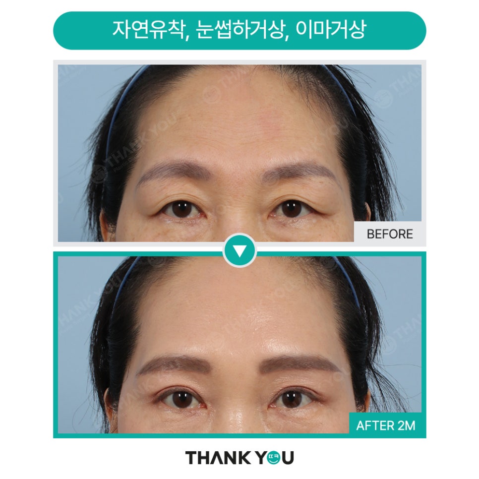 쌍꺼풀수술 없이 처진 눈 해결? [중년 이마거상/ 눈썹하거상술] 관련 이미지 7