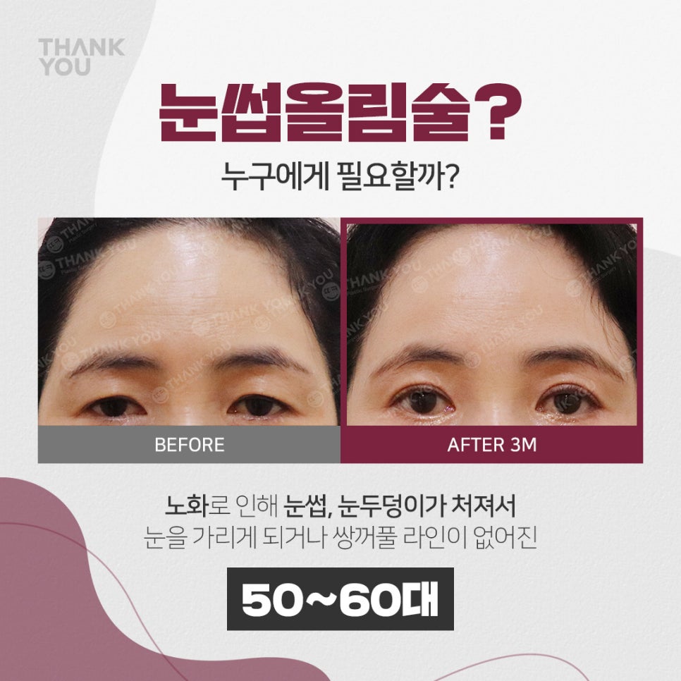 엔도타인 이마거상 찾는다면?시니어&주니어 눈썹올림술 관련 이미지 4