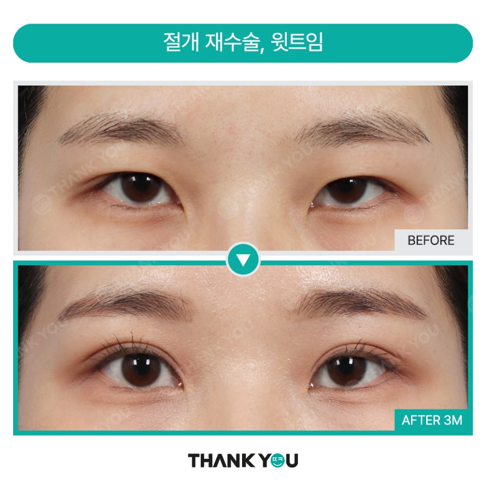 가로로 긴 눈은 어떤 쌍꺼풀라인이 어울릴까요? 관련 이미지 12