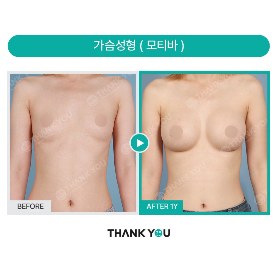자연스럽고 트렌디한 가슴수술, 모티바 전용룸에서 (가슴 전후) 관련 이미지 17