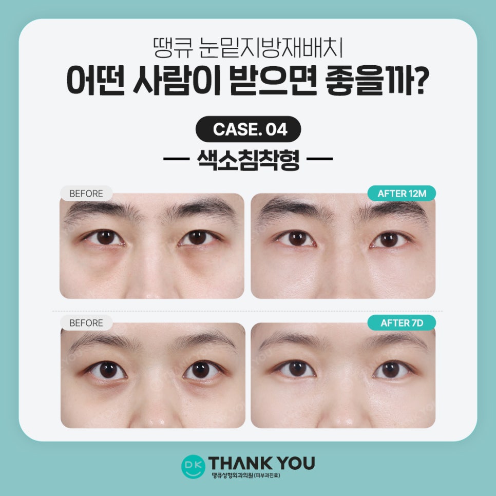 Under-Eye Fat Repositioning Event! Special Benefits for Exam Takers Prepared by Thank You 💫 image 7