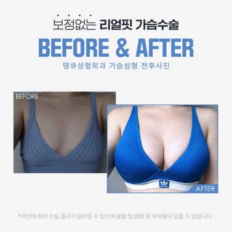 가슴지방이식수술 경험이 있을 경우, 재수술에 해당될까? 관련 이미지 4