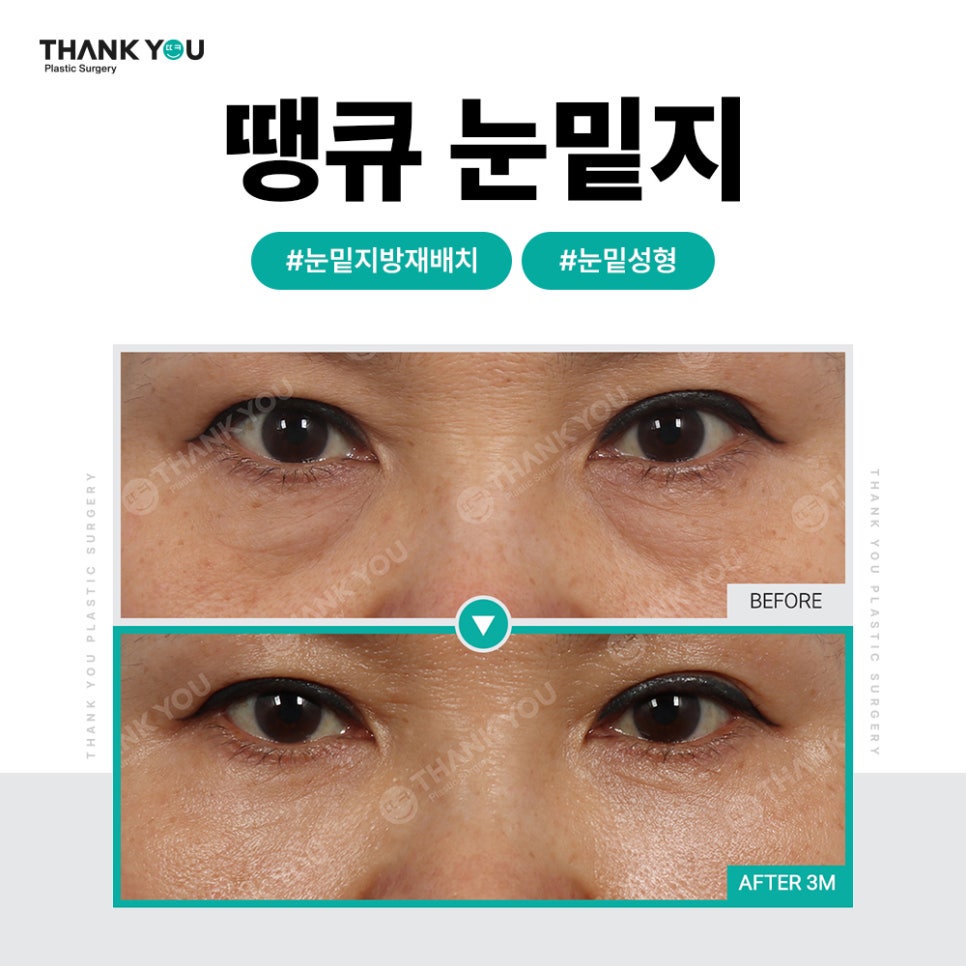 눈밑 불룩, 눈밑지 대신 눈밑지방제거만 단독으로? 관련 이미지 9