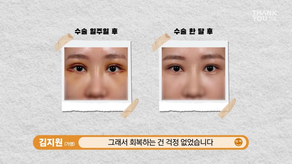 엄빠 몰래 이마거상 성공! (뒤밑트임 후기) 관련 이미지 14