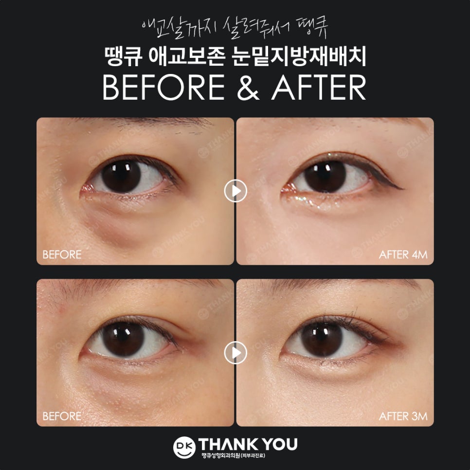 A Place That Does Lower Eyelid Fat Repositioning Well — Complete a Smooth, Refreshed Under-Eye Look at Thank You! image 9