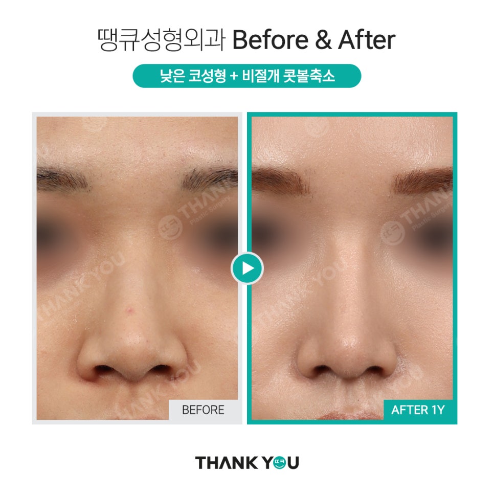 짧은코 교정의 역발상, 짧은코 성형 전후 관련 이미지 11