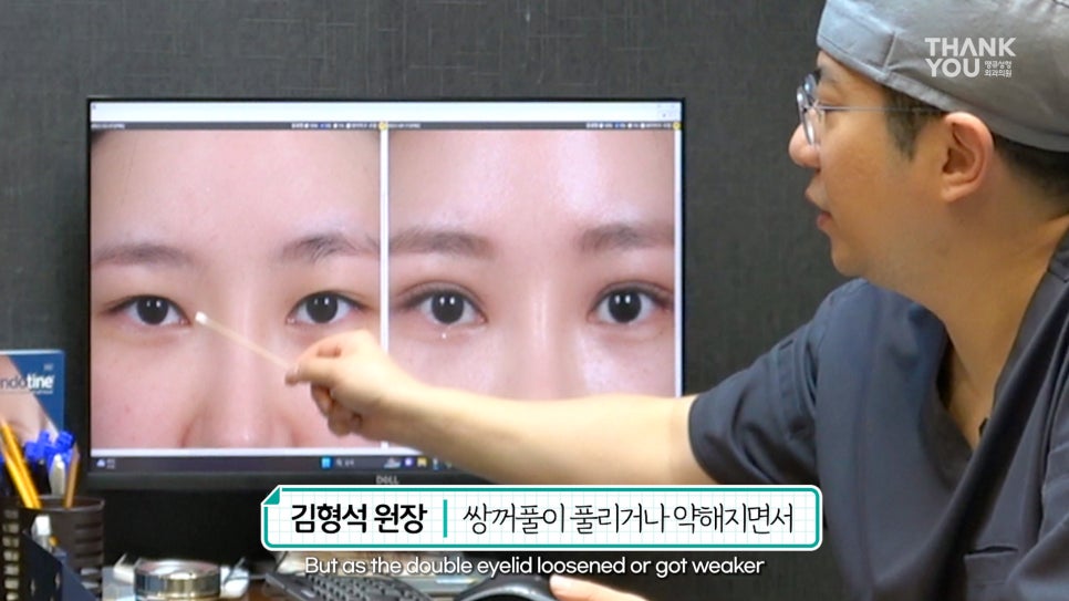 쌍수에 눈썹올림술을 추천하는 이유?! 관련 이미지 4