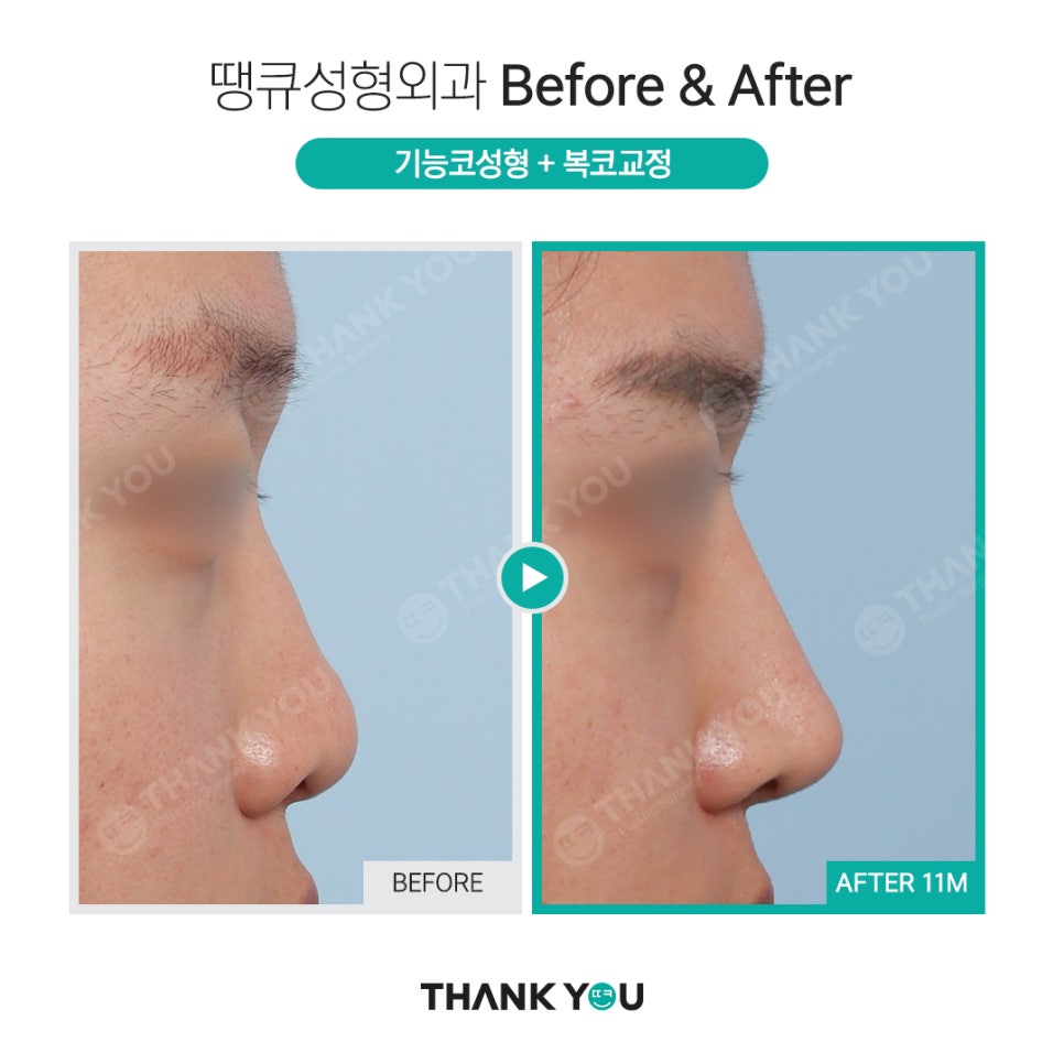 강남 코성형 전후, 코수술 잘하는 곳? 관련 이미지 3