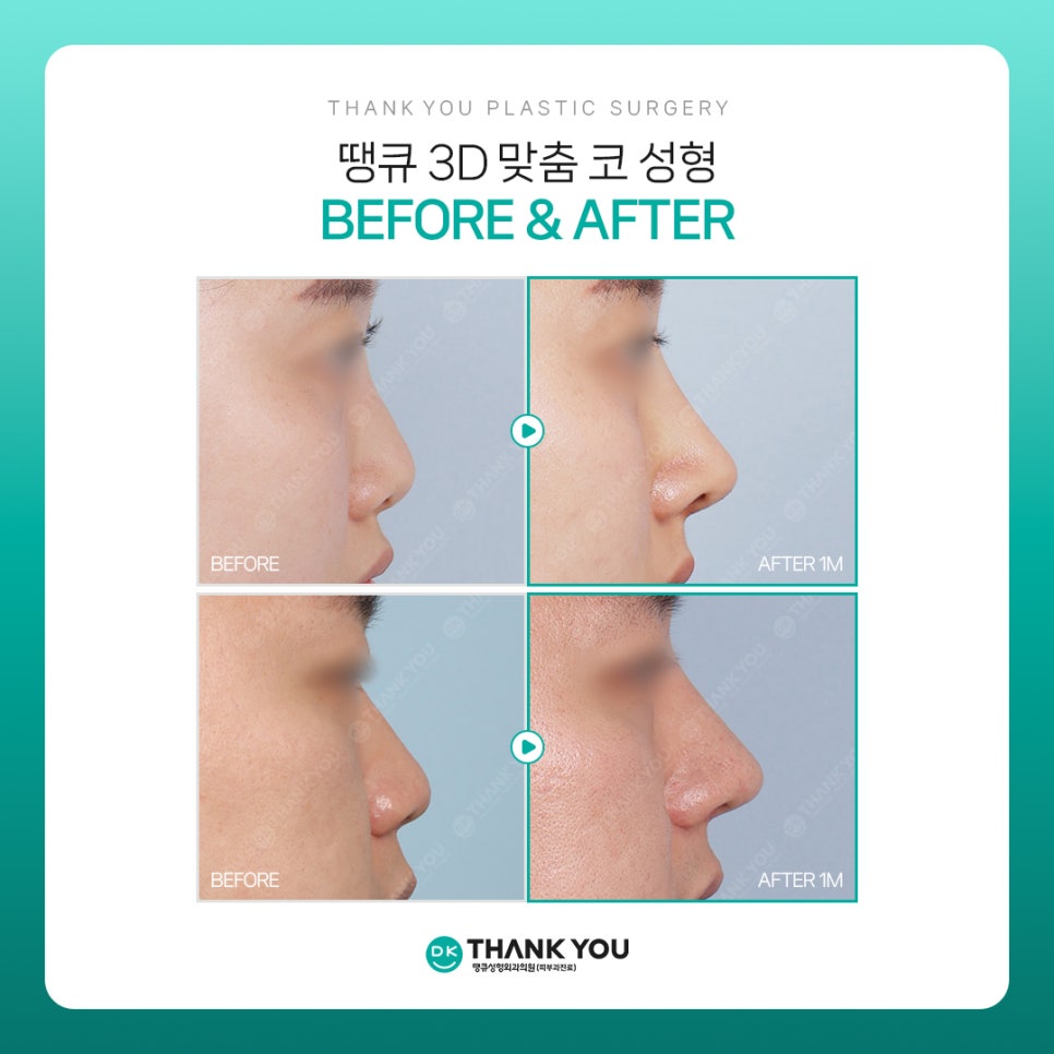 코성형전후, 만족스러운 차이를 얻고 싶다면?! 3D 맞춤 보형물 주목! 관련 이미지 6