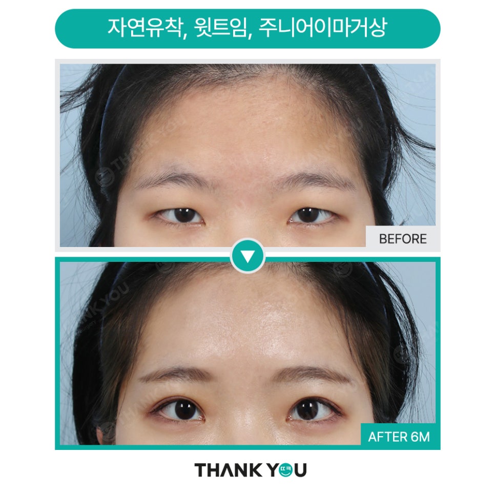 쌍꺼풀 풀림 쌍수 라인 풀림 증상? 이마거상수술로 개선! 관련 이미지 21