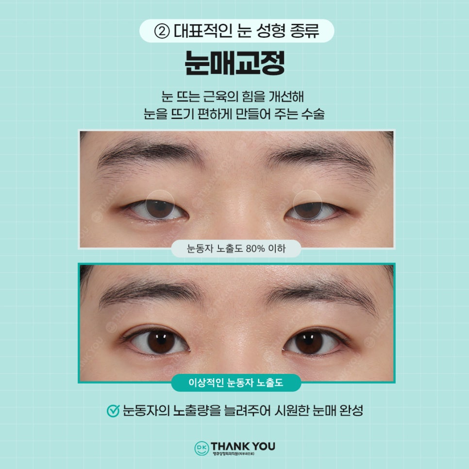 첫눈성형, 자연스럽고 조화로운 결과를 위해서는?! 관련 이미지 3