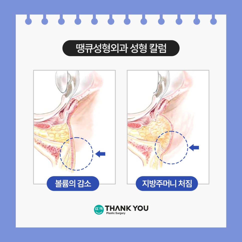 눈밑 필러 넣었는데 눈밑지방재배치 가능할까요? (이호준 칼럼) 관련 이미지 2
