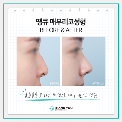 매부리코개선 맞춤 디자인으로 원하던 워너비 코 완성! 관련 이미지 5
