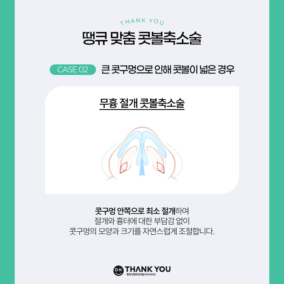 콧볼축소술, 케이스에 따른 맞춤 수술 방법은? 관련 이미지 5