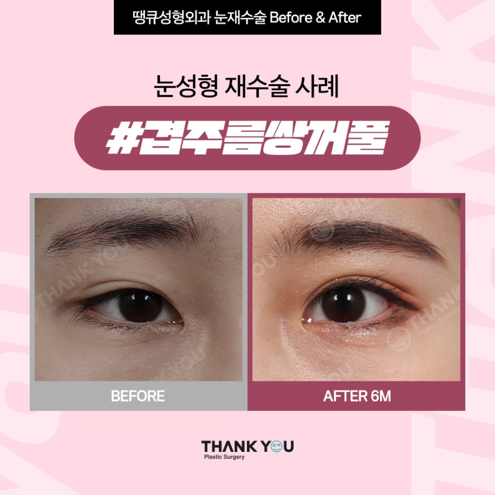 짝눈 교정, 쌍수 재수술 시기 알려드려요 관련 이미지 8