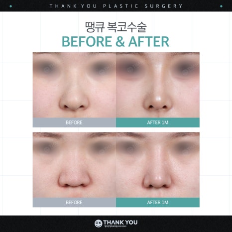 A Great Bulbous Nose Surgery Review: Making a Slim Nose at Thank You! image 7